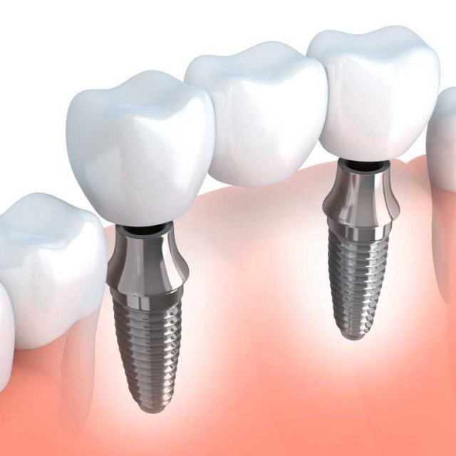 Dental Implants