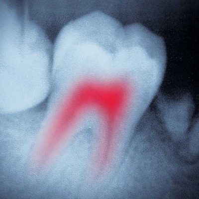 Root Canals