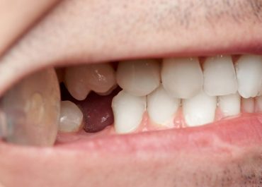 How Missing Teeth Can Affect Your Health